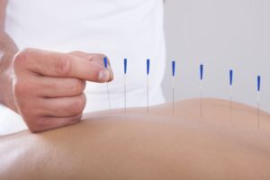 acupuncture chemotherapy